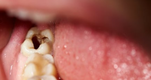 Cara Menghilangkan Bau Mulut Akibat Gigi Berlubang